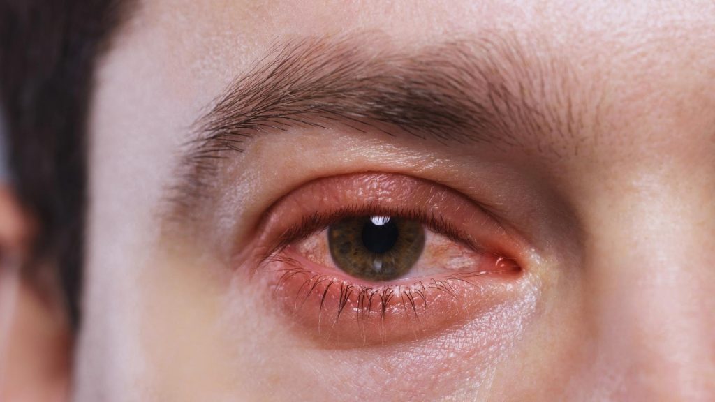 meth eyes are often defined by dilated pupils