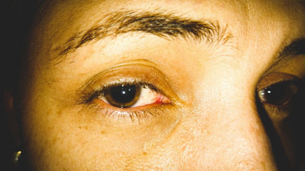 meth eyes often are most noticeable due to light sensitivity