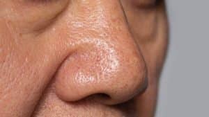 Alcoholic Nose hero image close-up of a man's nose.