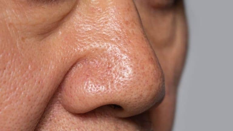 Alcoholic Nose hero image close-up of a man's nose.