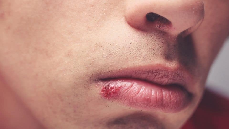 Meth Face is a phenomenon where open sours and skin flakes can change your appearance.