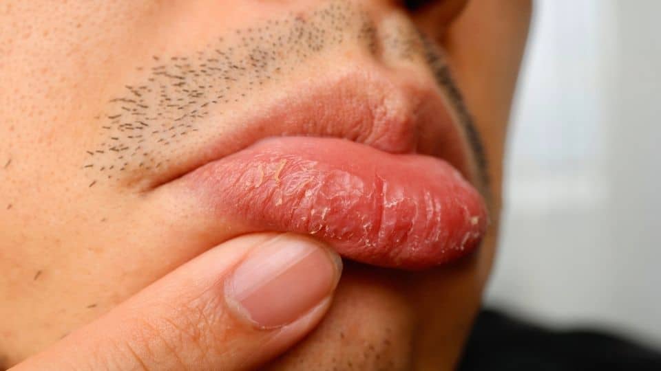 Meth Face may result in cracked lips.